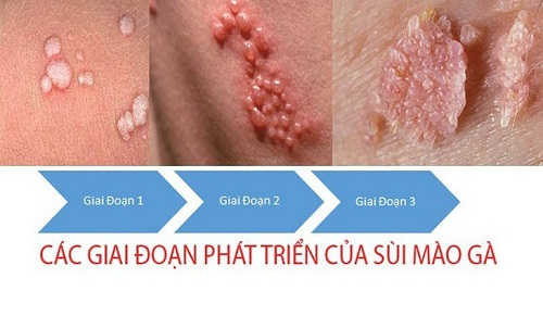 Các giai đoạn phát triển sùi mào gà