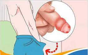 Cách chữa bao quy đầu bị sưng phồng lên như cục mỡ 