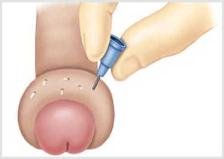 Cách chữa bao quy đầu bị sưng phồng lên như cục mỡ 