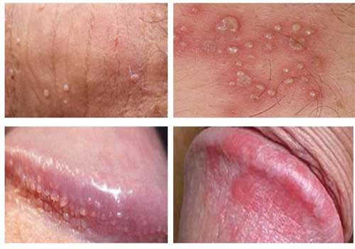 Cách chữa viêm bao quy đầu tại nhà