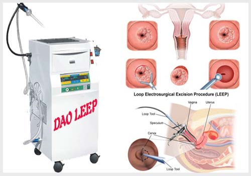 Tìm hiểu phương pháp chữa viêm lộ tuyến cổ tử cung tốt nhất hiện nay