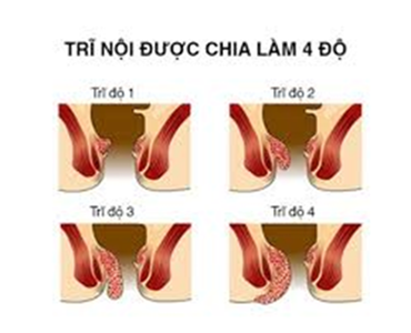 Bệnh trĩ nội là căn bệnh khó phát hiện và khó chữa nhất trong các loại bệnh trĩ