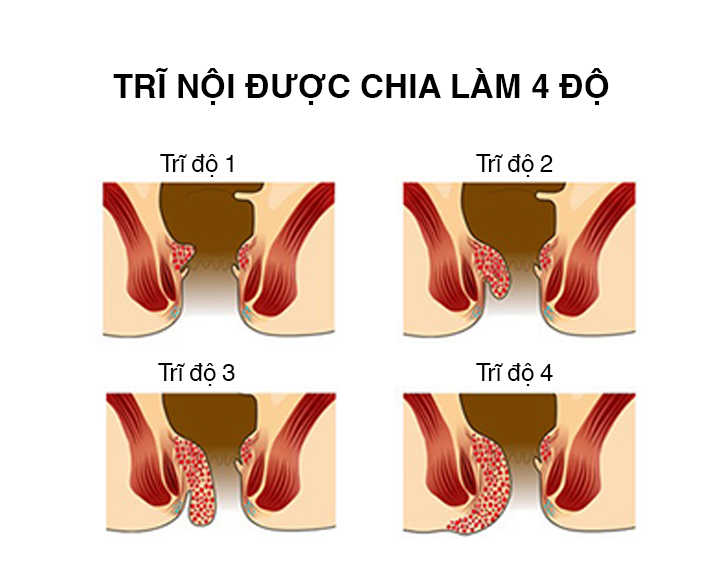 Làm sao biết bị trĩ nội và hướng điều trị theo từng cấp độ bệnh