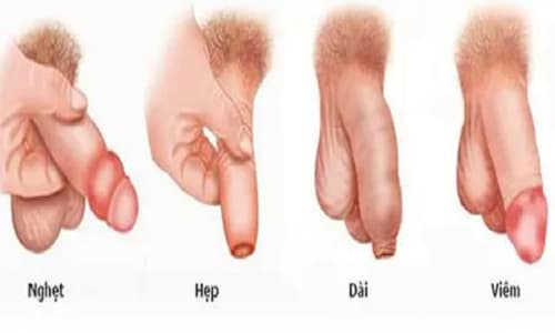 [Thắc mắc] Cắt bao quy đầu để làm gì?