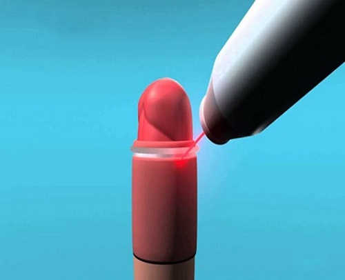 Cắt bao quy đầu bằng phương pháp laser