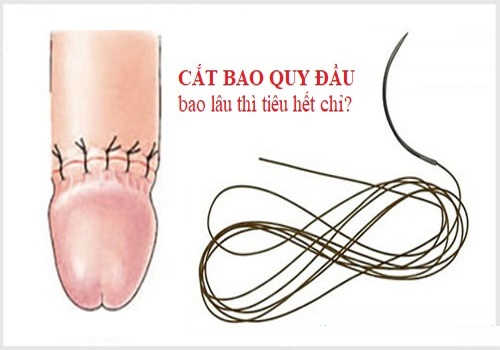 Thông thường, khoảng 10 ngày chỉ tự tiêu