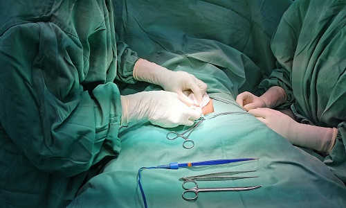 Cắt bao quy đầu phương pháp truyền thống
