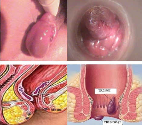 Tại sao khi mổ trĩ xong lại có thịt lòi ra ở hậu môn