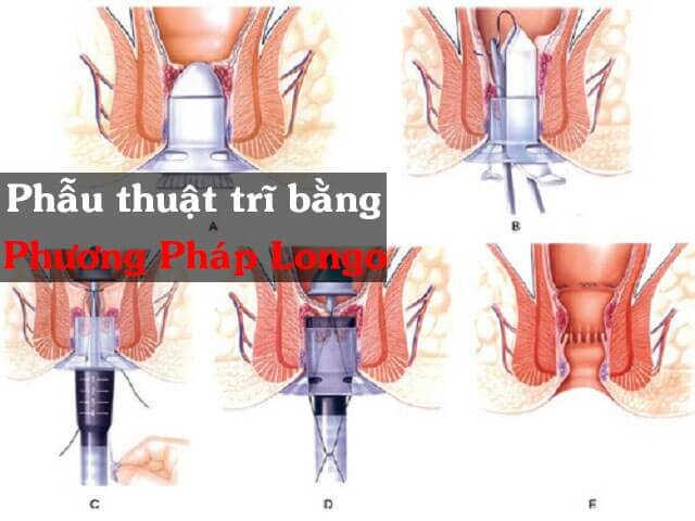 Kinh nghiệm đi cắt trĩ an toàn, triệt để không đau không tái phát