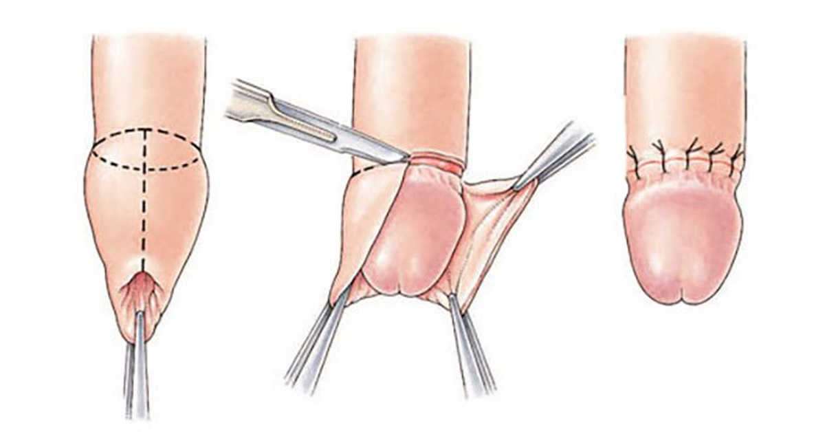 Câu hỏi thường gặp khi cắt bao quy đầu