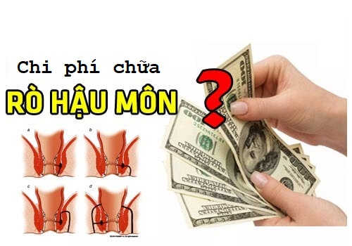 Chi phí chữa bệnh rò hậu môn có tốn kém không?