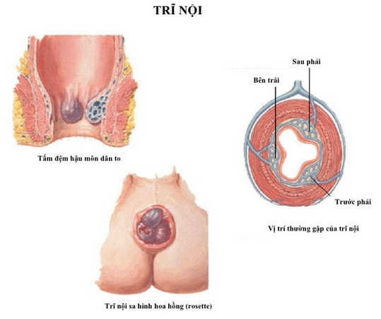 Cách chữa bệnh trĩ nội tại nhà hiệu quả từ người bệnh