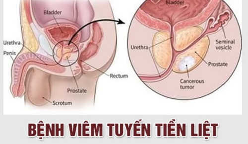 Bệnh viêm tuyến tiền liệt