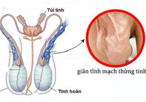 Theo quan niệm Đông y bệnh giãn tĩnh mạch thừng tinh là gì?