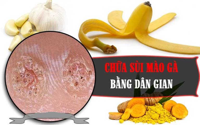 Sùi mào gà thường mọc ở đâu, cách chữa tại nhà hiệu quả