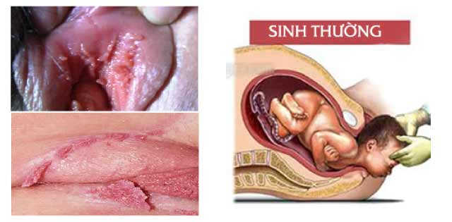 Thai phụ bầu 8 tháng bị sùi mào gà ảnh hưởng thai nhi không?