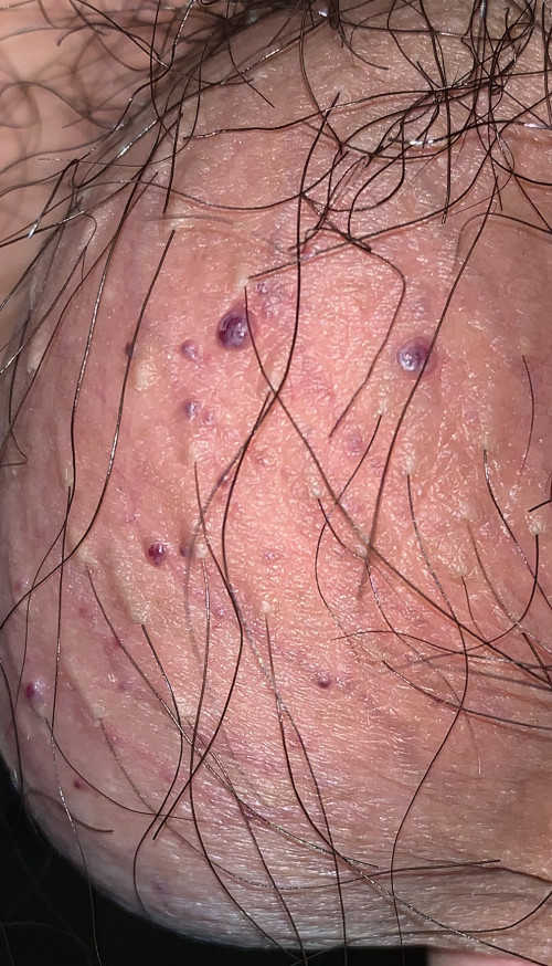 Do bệnh viêm da tiếp xúc