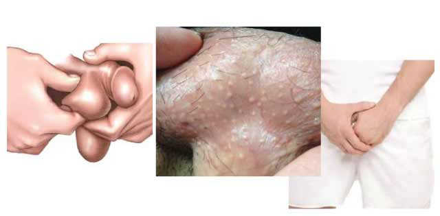 Bệnh viêm tinh hoàn và cách điều trị hiệu quả