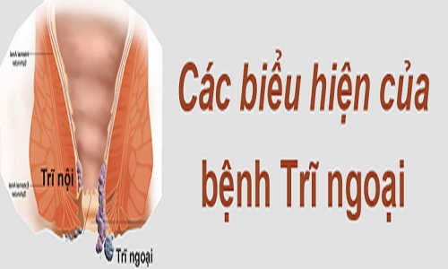 Bệnh trĩ ngoại