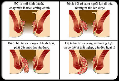 Dấu hiệu bệnh trĩ nội là cơ sở để người bệnh nhận biết sớm