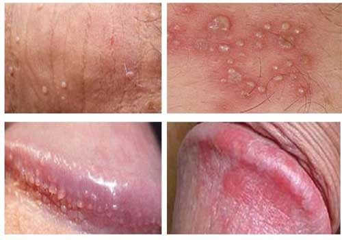 Dấu hiệu viêm bao quy đầu ở nam giới