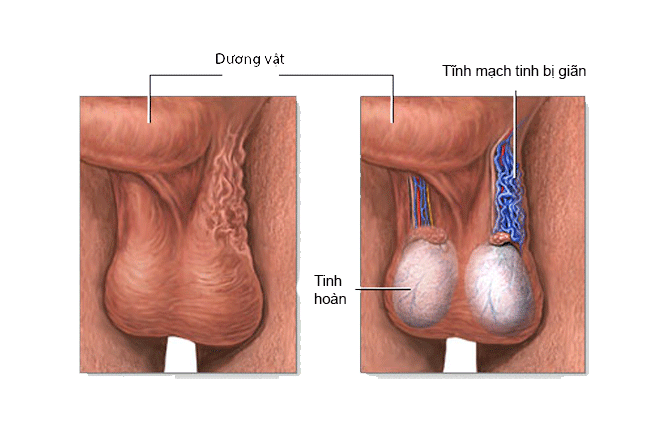 Đau ở tinh hoàn phải do vỡ tinh hoàn