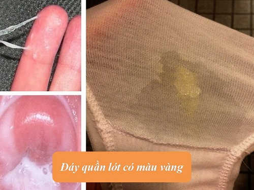Đáy quần lót có màu vàng