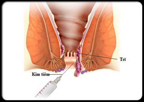 Điều trị bệnh trĩ ngoại bằng tiêm