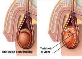 Những biến chứng viêm tinh hoàn sau quai bị