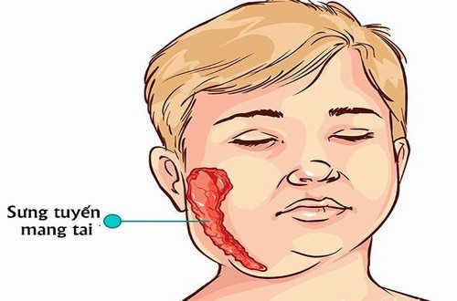 Phương pháp điều trị viêm tinh hoàn sau quai bị hiệu quả