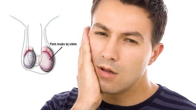 Phương pháp điều trị viêm tinh hoàn sau quai bị hiệu quả