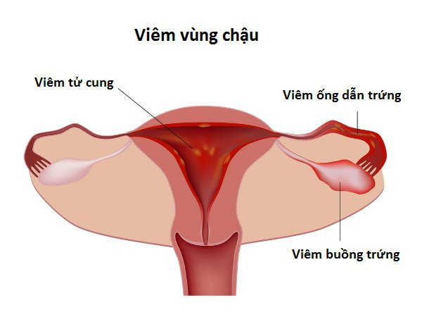 Do bệnh viêm vùng chậu