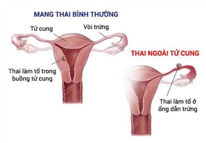 Do mang thai hoặc thai ngoài tử cung