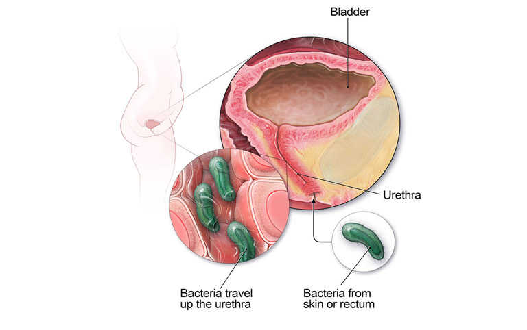 Do nhiễm trùng đường tiết niệu