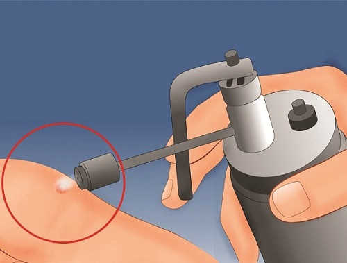 Điều trị sùi mào gà bằng laser