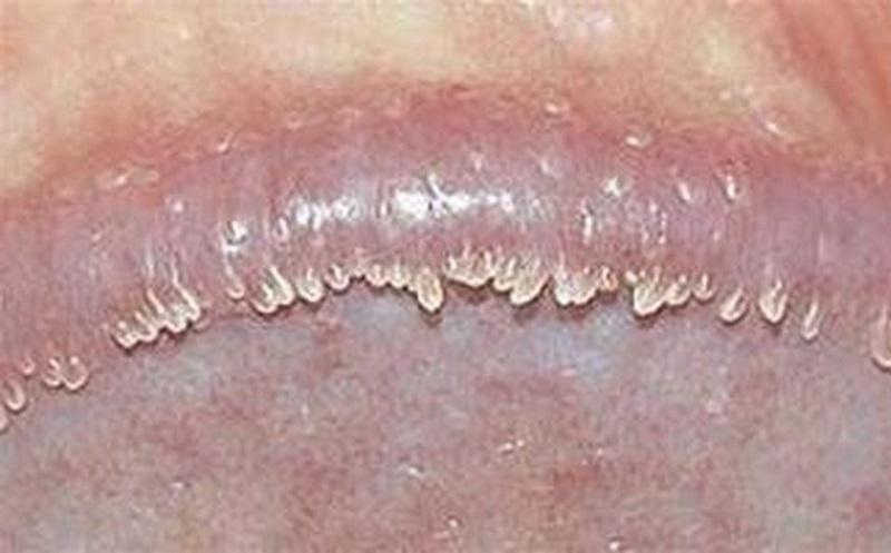 Dương vật có mụn nhỏ ở bao quy đầu là bệnh gì?