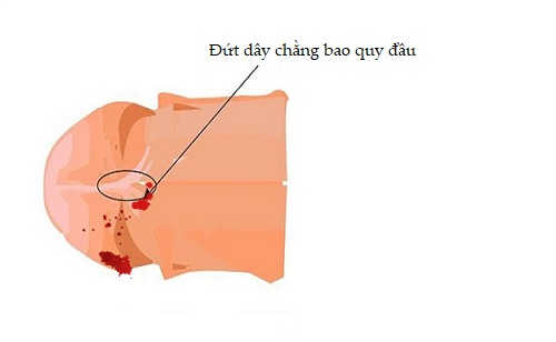 Đứt dây chằng bao quy đầu