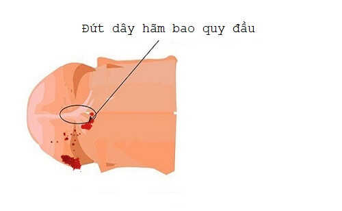 Đứt dây hãm bao quy đầu khiến dương vật chảy máu