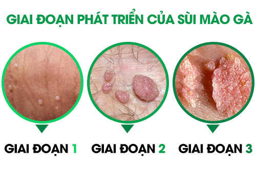 Sùi mào gà thường mọc ở đâu, có chữa được không
