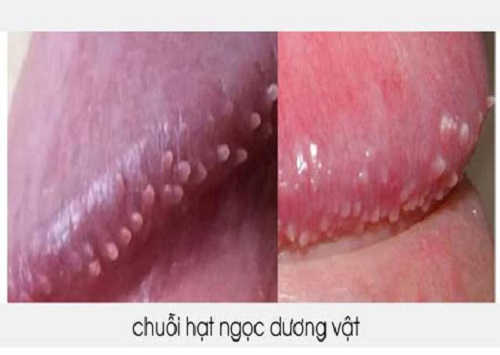 Chuỗi hạt ngọc dương vật