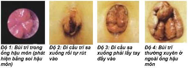 Phương pháp điều trị trĩ độ 4 hiệu quả nhất hiện nay là gì