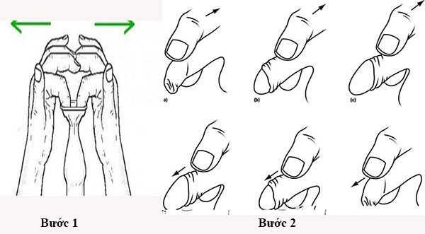 Hướng dẫn cách nong giãn bao quy đầu cho nam giới