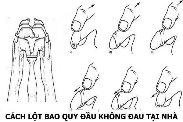 Nong giãn bao quy đầu là gì? 