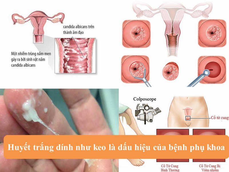 Huyết trắng đặc như keo: Nguyên nhân, tác hại, cách khắc phục