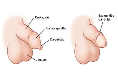 Khi nào cần cắt bao quy đầu? Phương pháp cắt an toàn