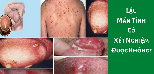 Bệnh lậu mãn tính có xét nghiệm được không?