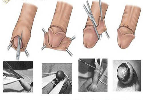 Lợi ích của cắt bao quy đầu cho nam giới