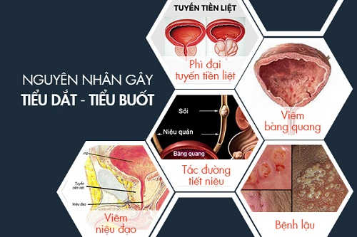 Nguyên nhân gây tình trạng tiểu buốt