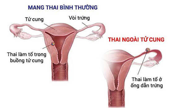 Mang thai ngoài tử cung