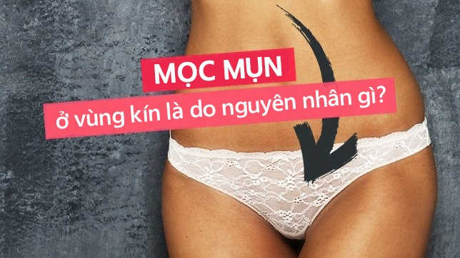 Nổi mụn ở bộ phận sinh dục nữ là bệnh gì? 5 cách khắc phục
